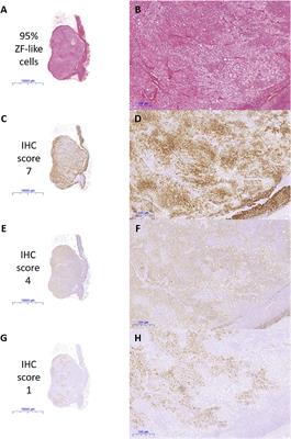 Prevalence and Histopathological Characteristics of KCNJ5 Mutant Aldosterone-Producing Adenomas in a Multi-Ethnic Malaysian Cohort